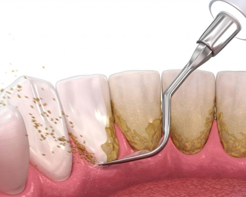 smiley-dental-lowell-cleaning-mobile