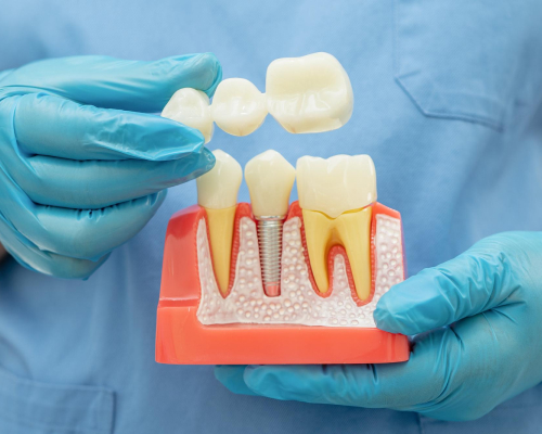 smiley-dental-lowell-crown-mobile