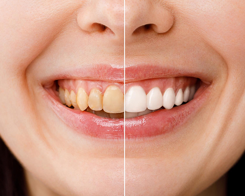 teeth-whitening
