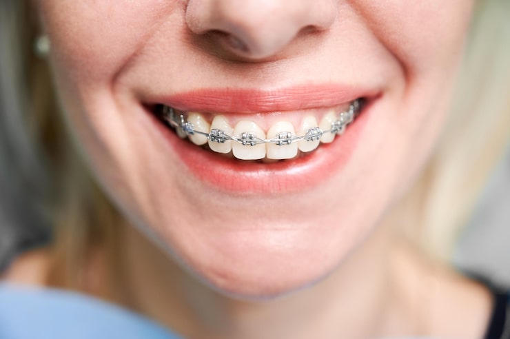 Tooth Coloured Braces in Lowell