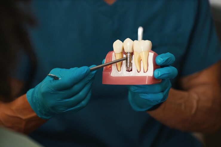 Dental Implants Take to Heal