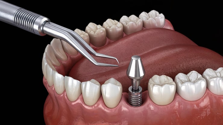 Surgical Dental Implants