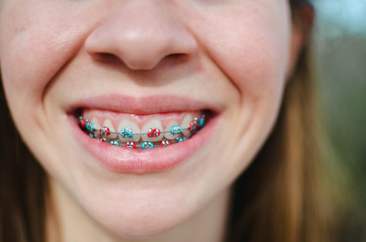 Tooth Colored Braces Treatment