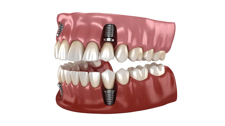 full mouth dental implants