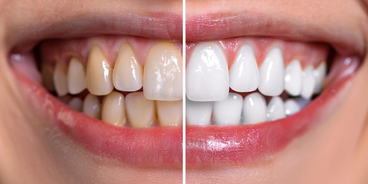 dental implants with gum disease