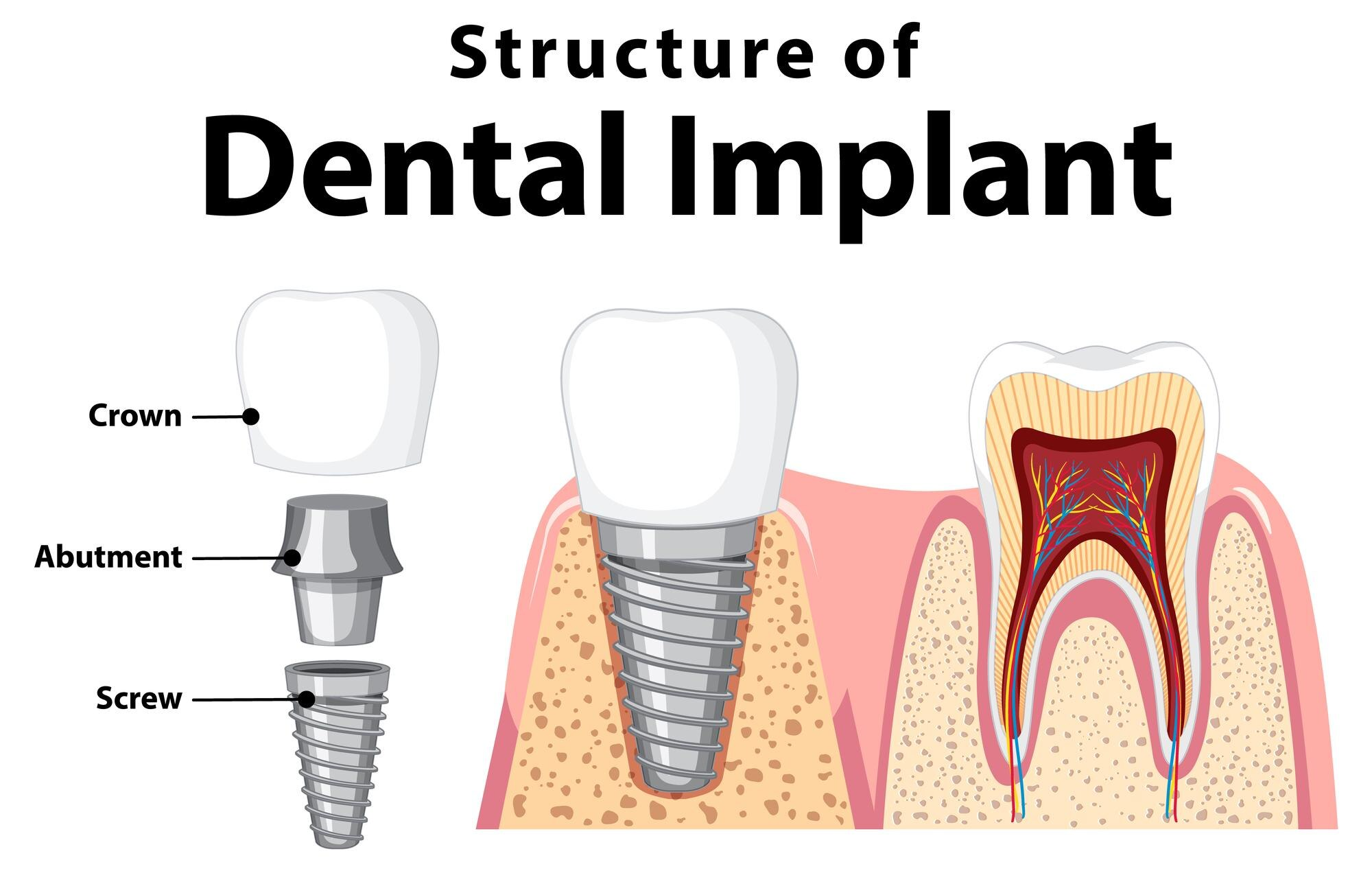 Is Surgical Dental Implant Placement Painful