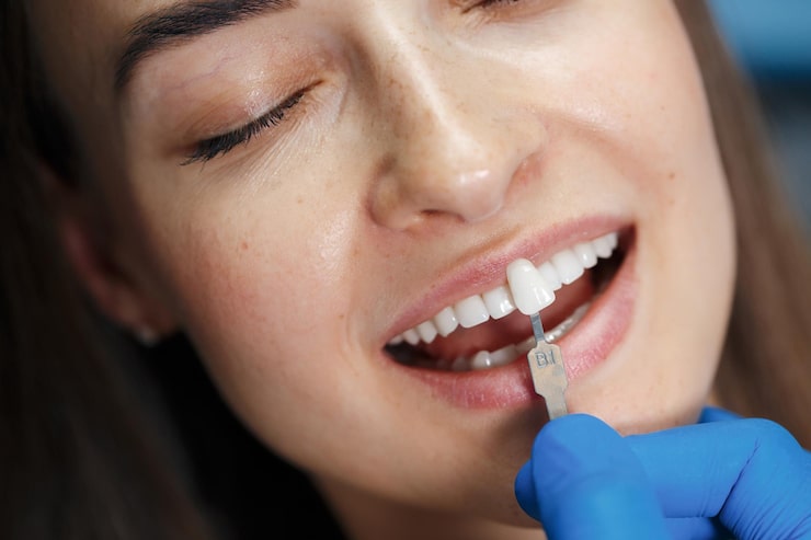 Teeth Filling Colors lowell