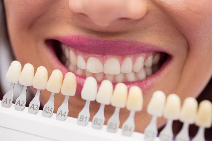 Teeth Filling Colors