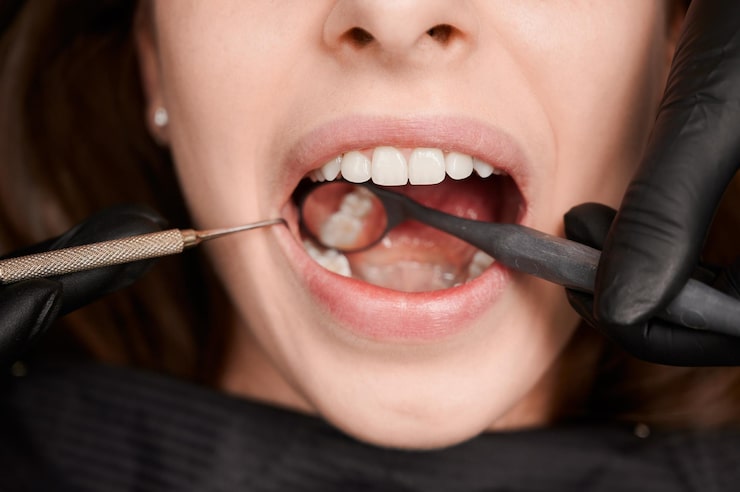 Tooth Colored Filling Cost in Lowell
