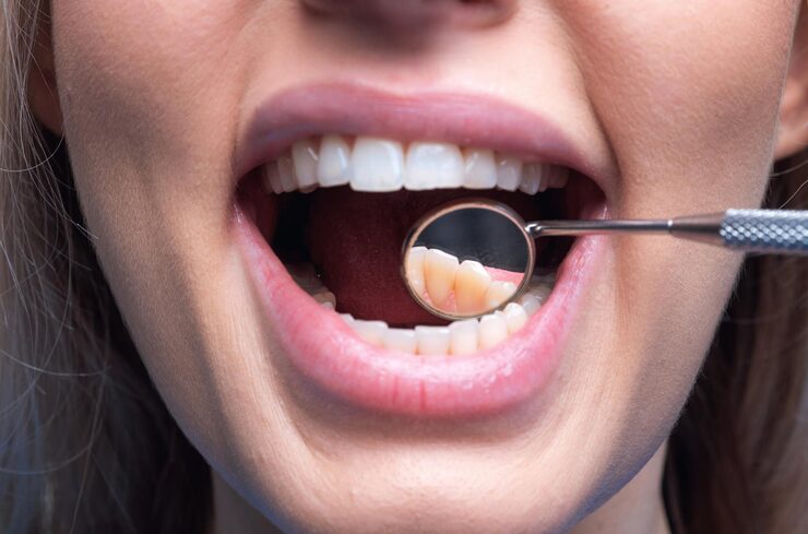 Composite Fillings