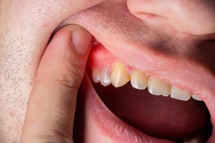 Gum Recession